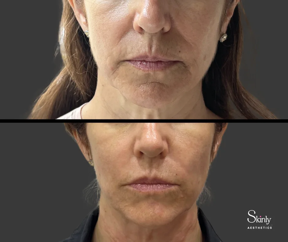 Restored facial harmony after laugh line injections.