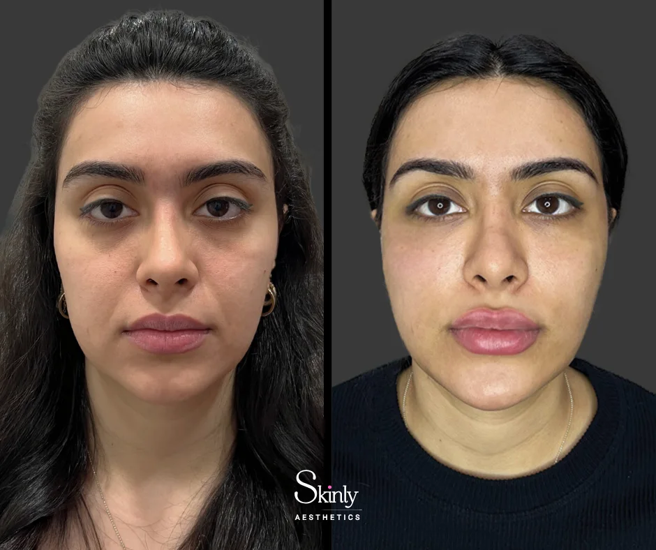 Filler treatment for smile lines, softening deep facial folds.