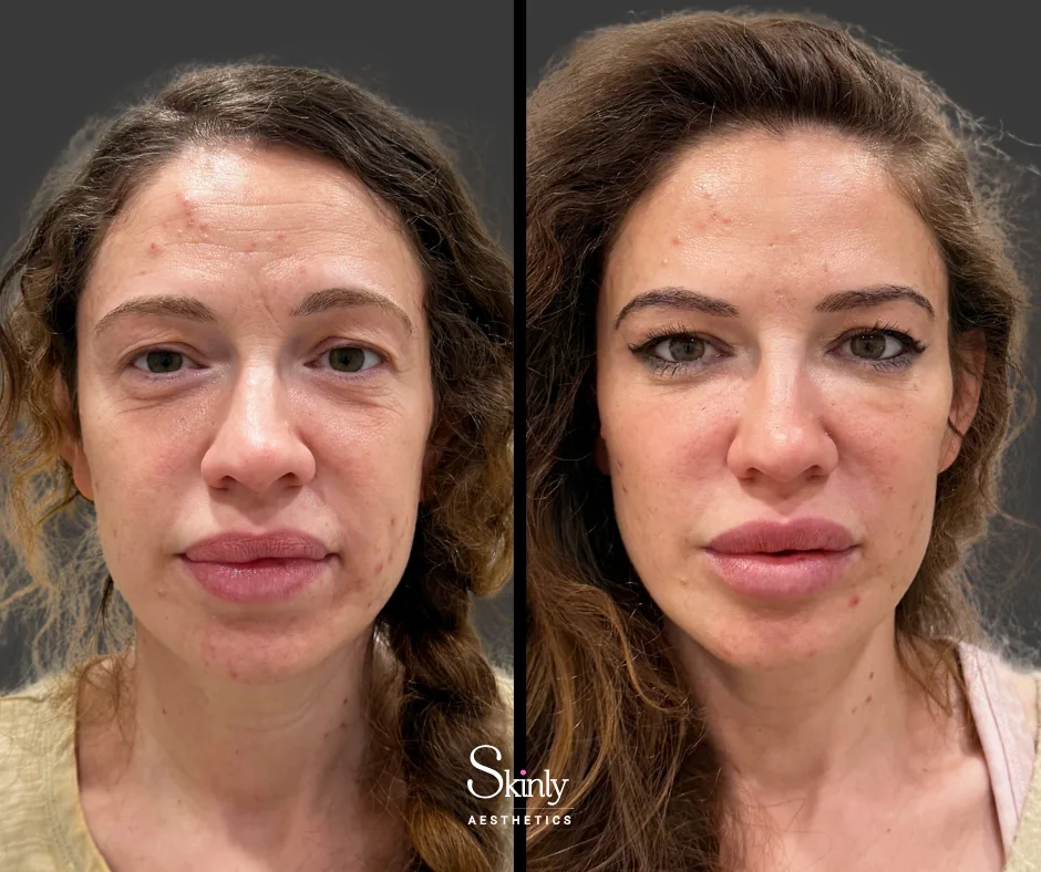 Deep static forehead wrinkles erased with filler – at Skinly Aesthetics in New York City.