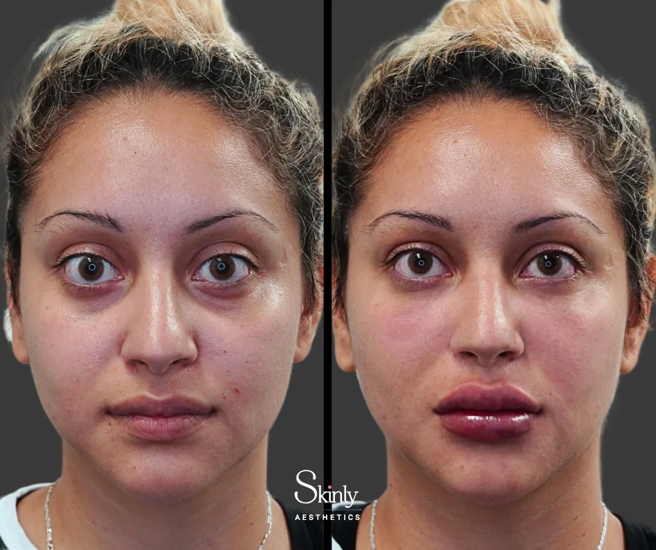 Enhanced definition and shape after lip filler at Skinly Aesthetics in New York City.