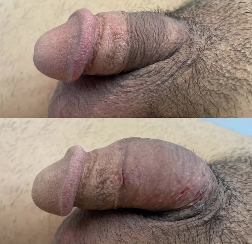 Girth enhancement after penile filler enhancement.