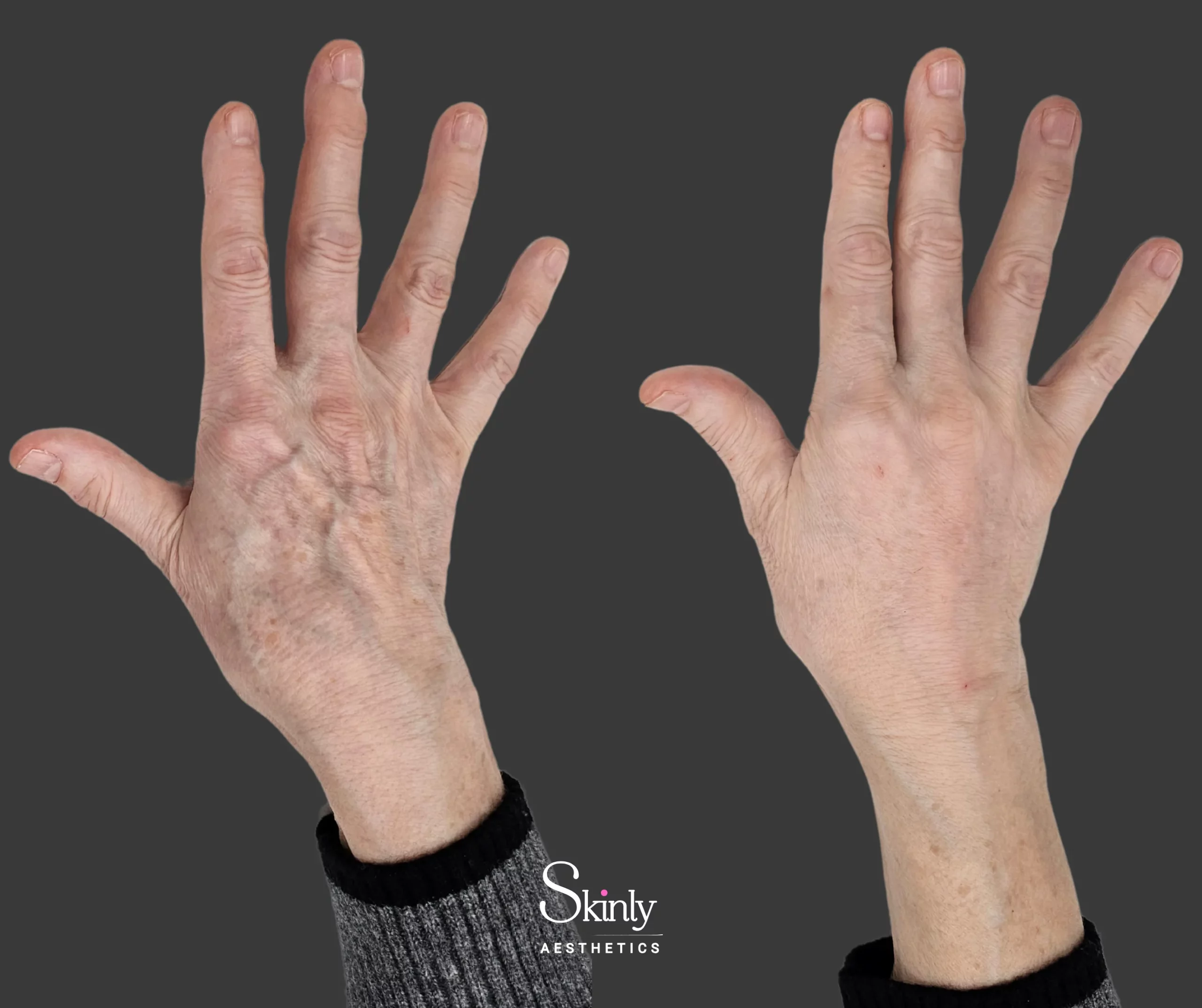 Radiesse & RHA fillers – immediate plumping with smoother texture and reduced vein visibility.