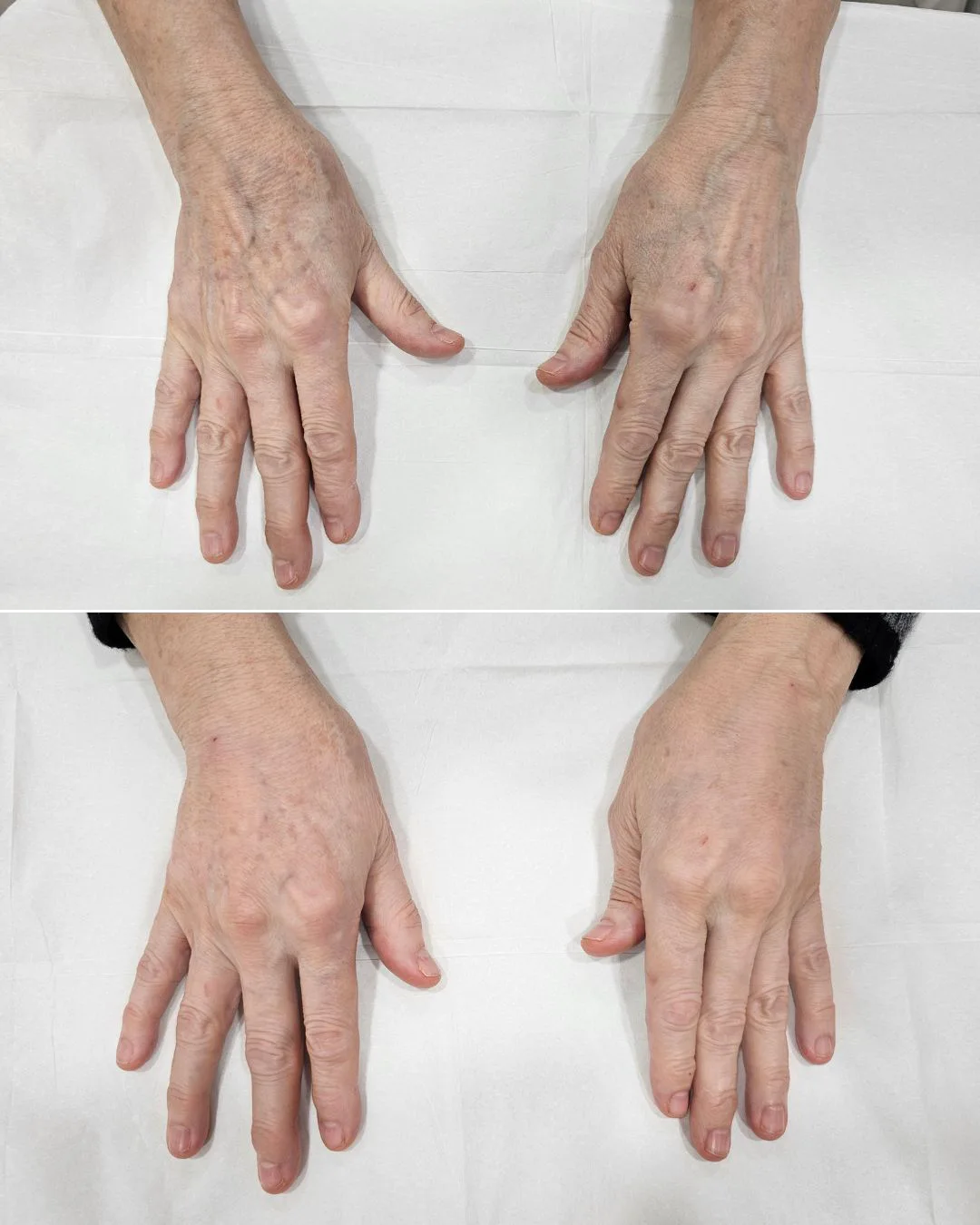 Juvederm Volbella + Radiesse – smooth skin, improved hydration, and natural fullness immediately after the injection