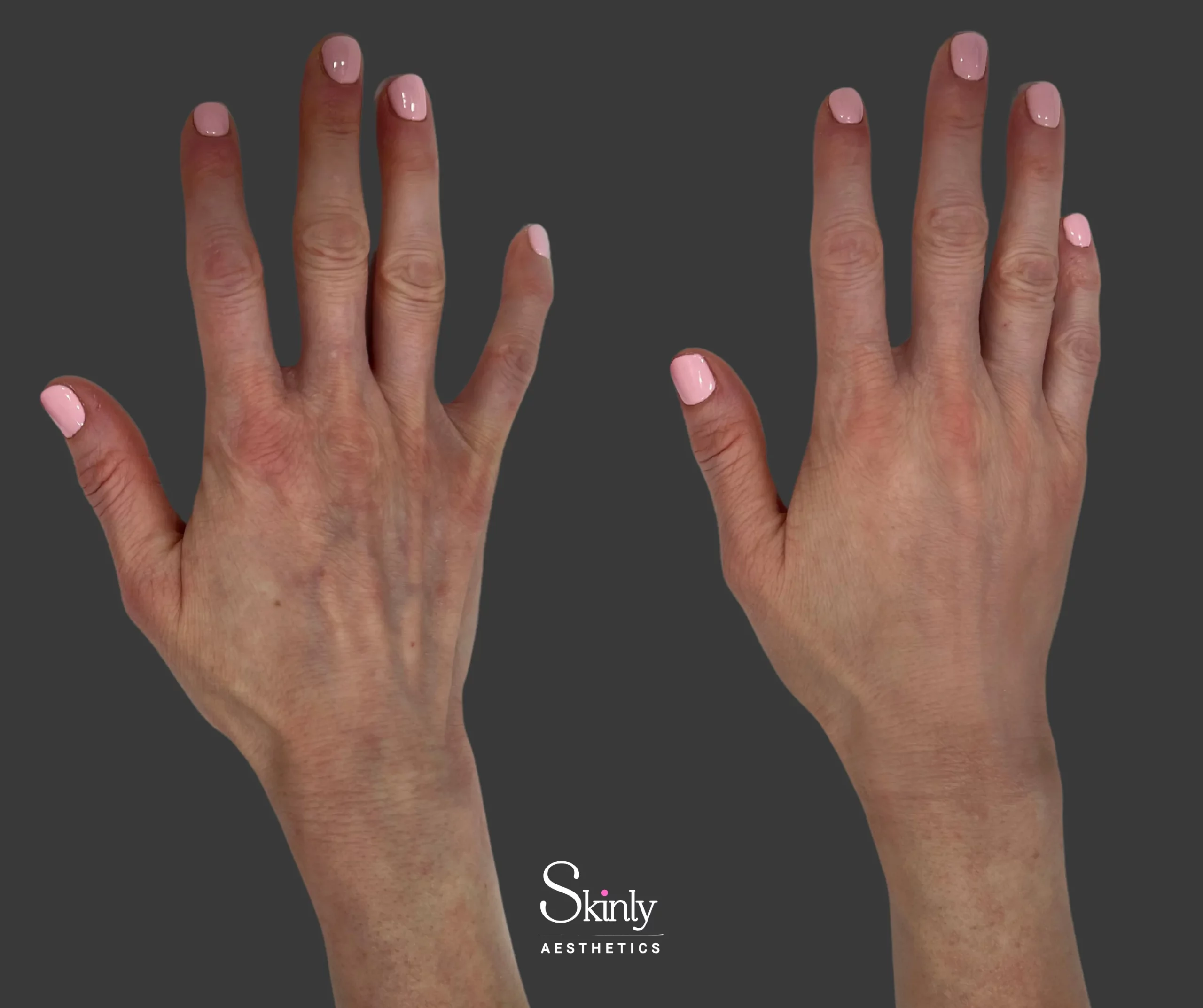Restylane + Radiesse hand injections – enhanced volume and collagen stimulation with youthful contour