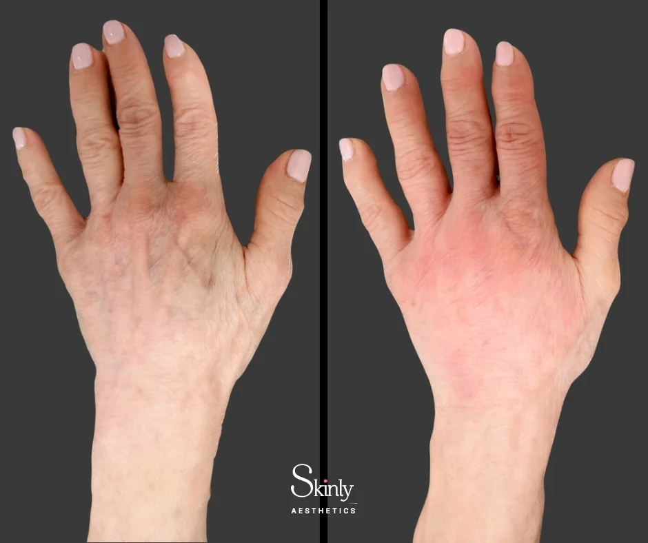 RHA & Radiesse mix used for enhanced volume and plumping of the hands