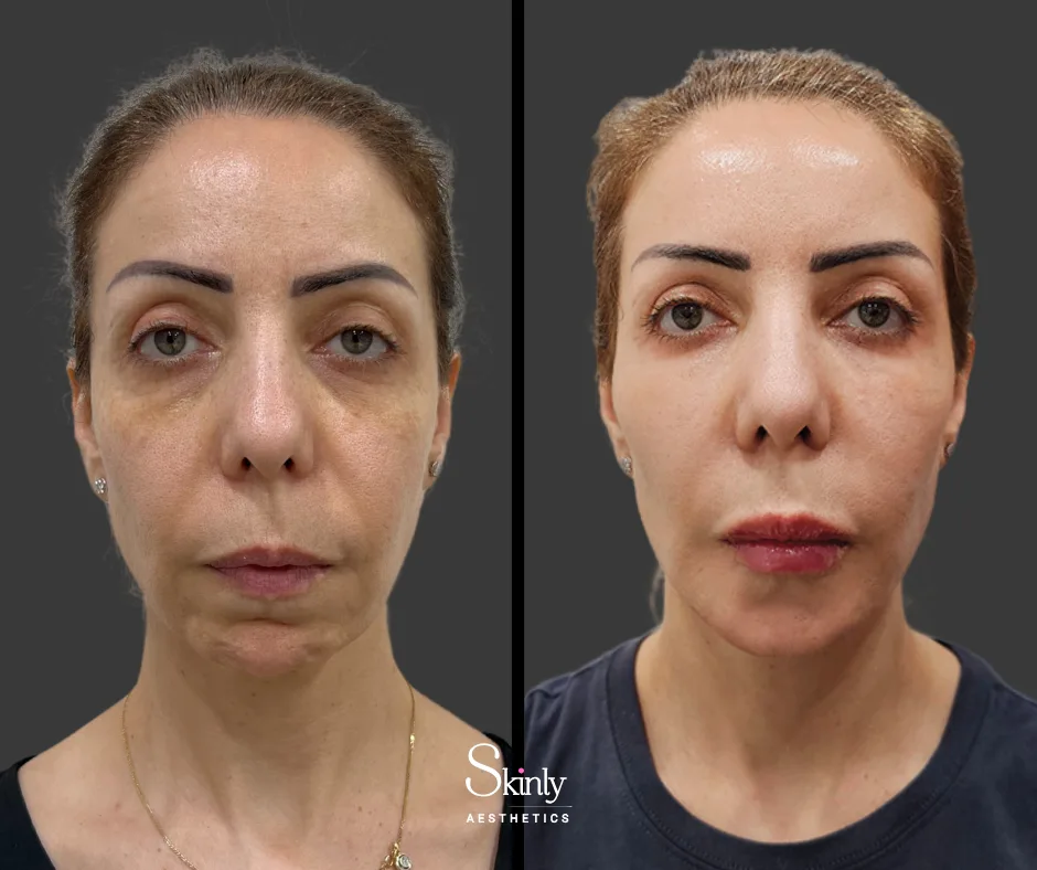 High cheekbones enhanced with cheek filler in New York City.