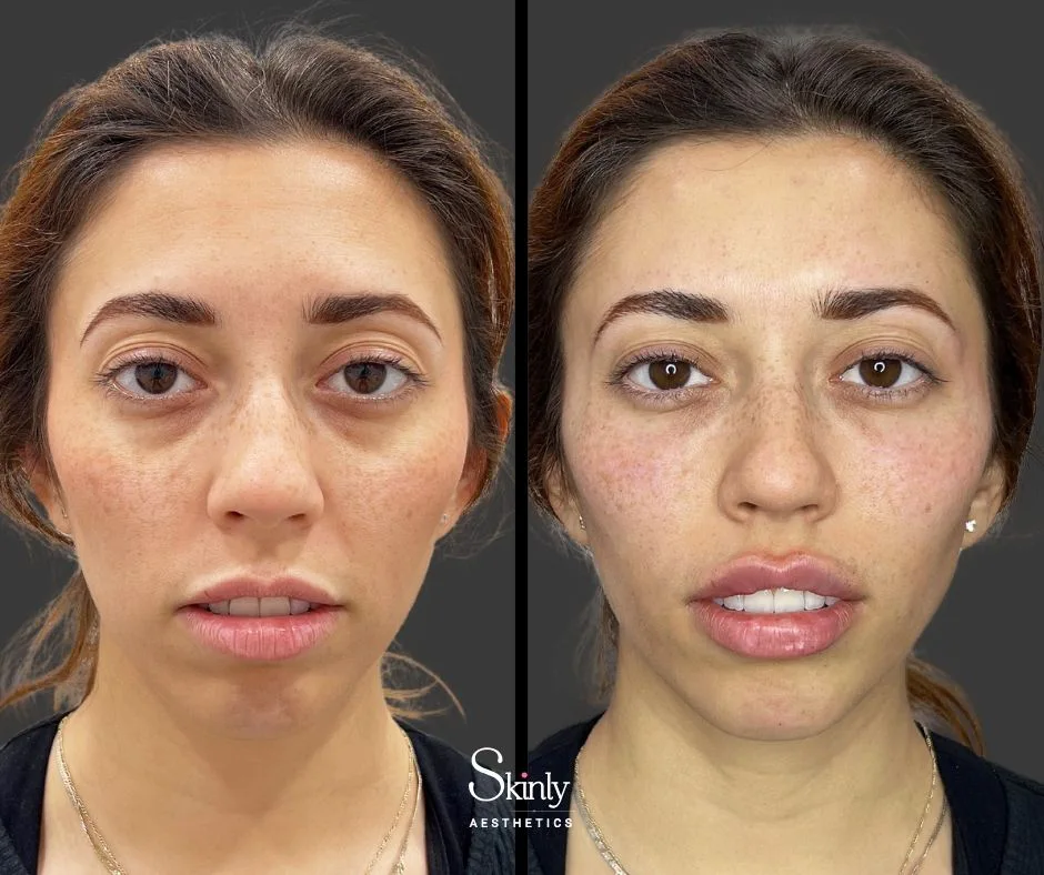 Hollow under eyes corrected with precise filler placement in NYC.