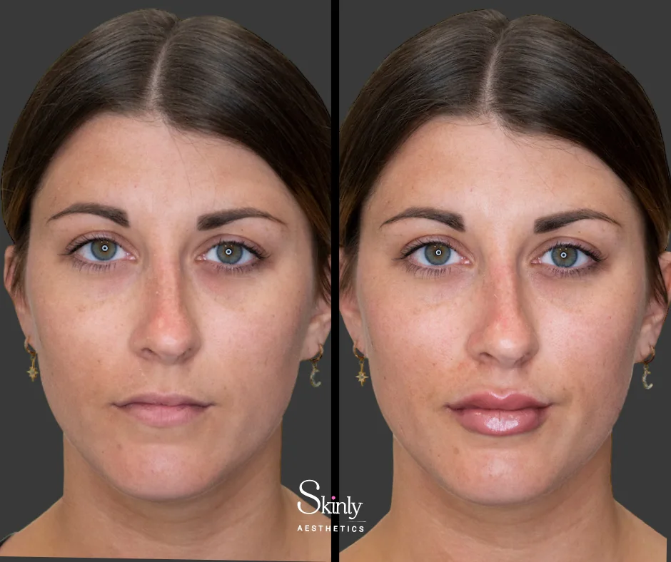 Hyaluronic acid lip filler adding fullness to the lips – in NYC.
