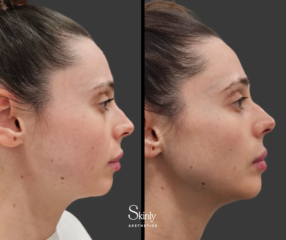 Jawline enhancement after filler injections by Dr. Schwarzburg at Skinly Aesthetics.
