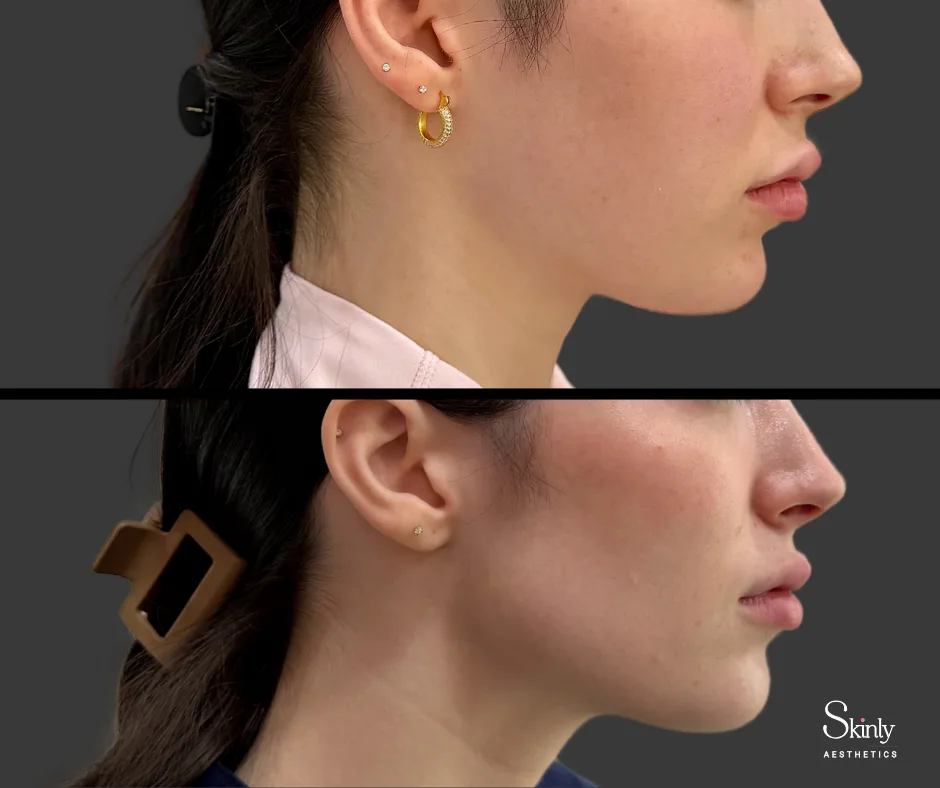 Defined side profile after Jawline filler treatment at Skinly Aesthetics medspa.