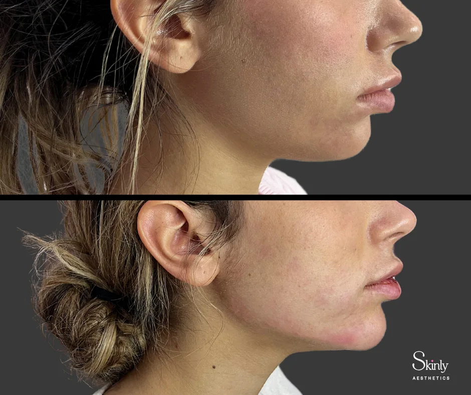 Jawline filler creating a more defined and sculpted side profile at our New York City clinic.