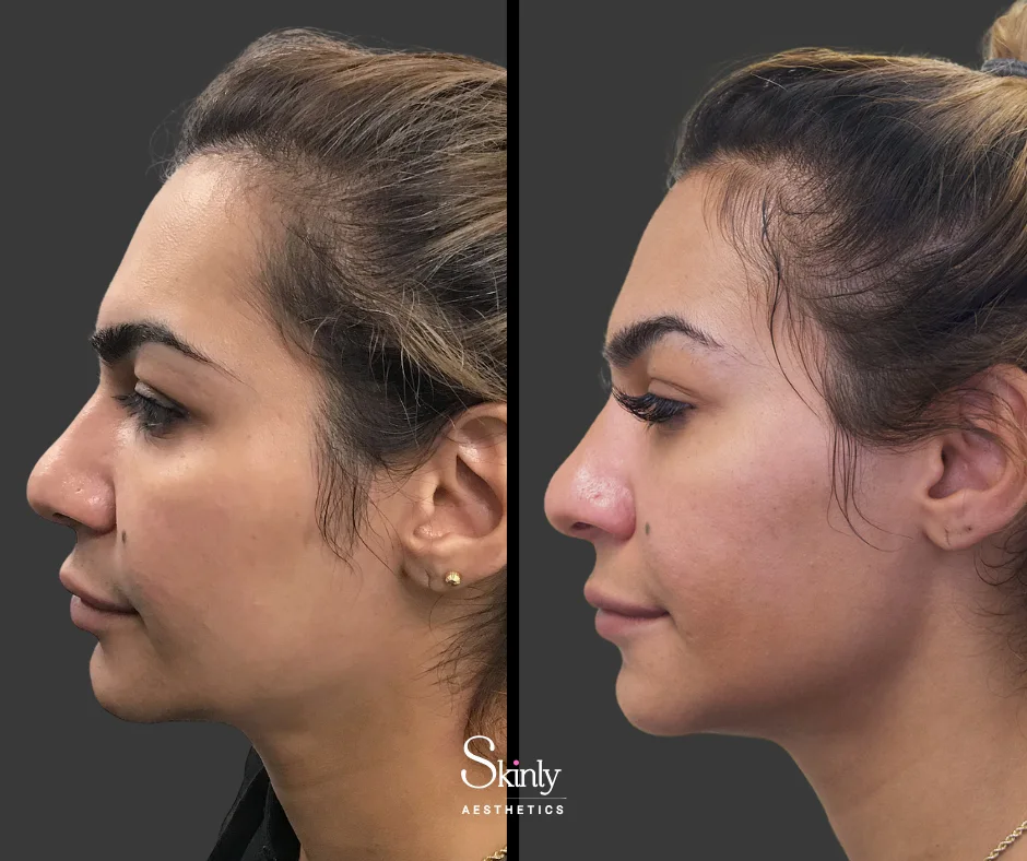 Female side profile refined with jawline filler at our New York City medspa.