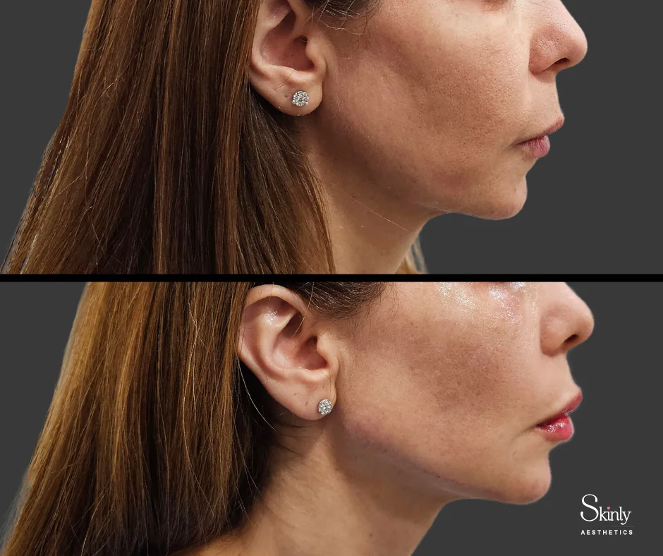 Refined jawline after dermal filler injections at Skinly Aesthetics