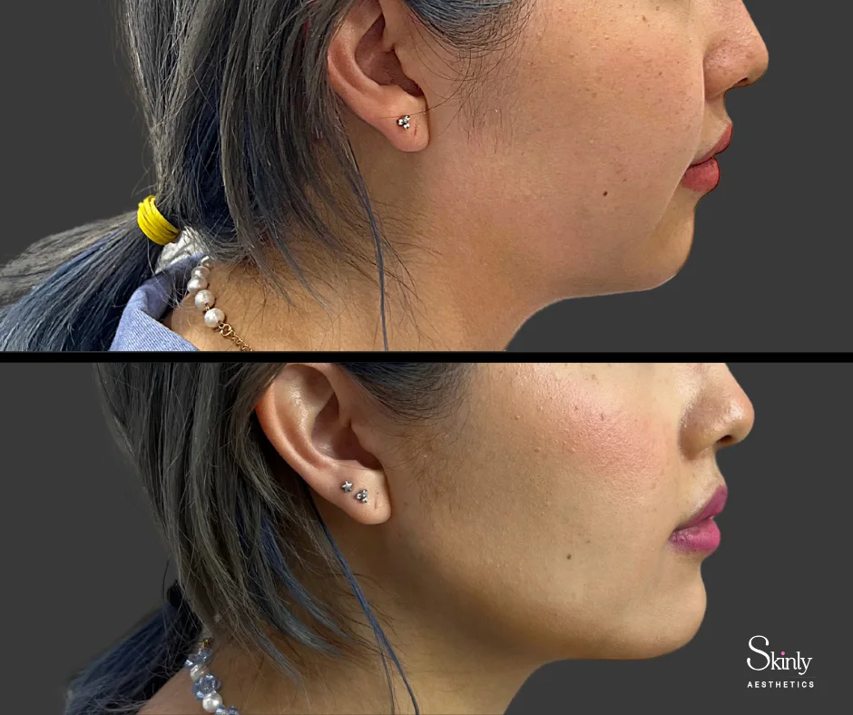 Jawline filler adding contour to the jawline – at our NYC clinic.