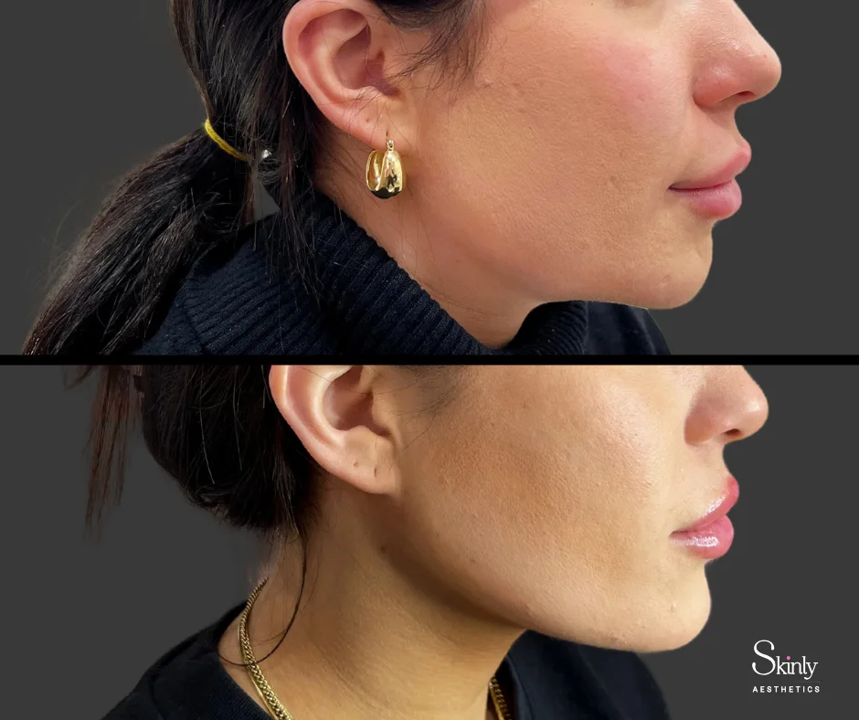 Enhanced jawline with dermal filler – before (top) vs after (bottom) at our NYC clinic.
