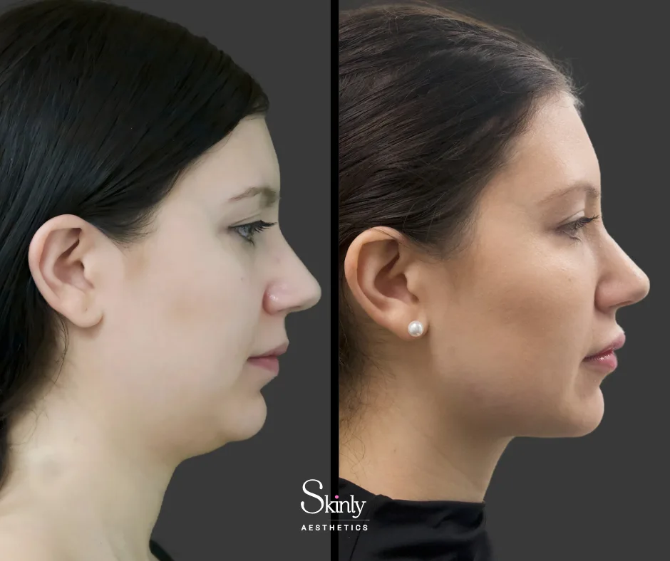 Reducing double chin fullness after Kybella injections – before (left) vs after (right) in NYC.