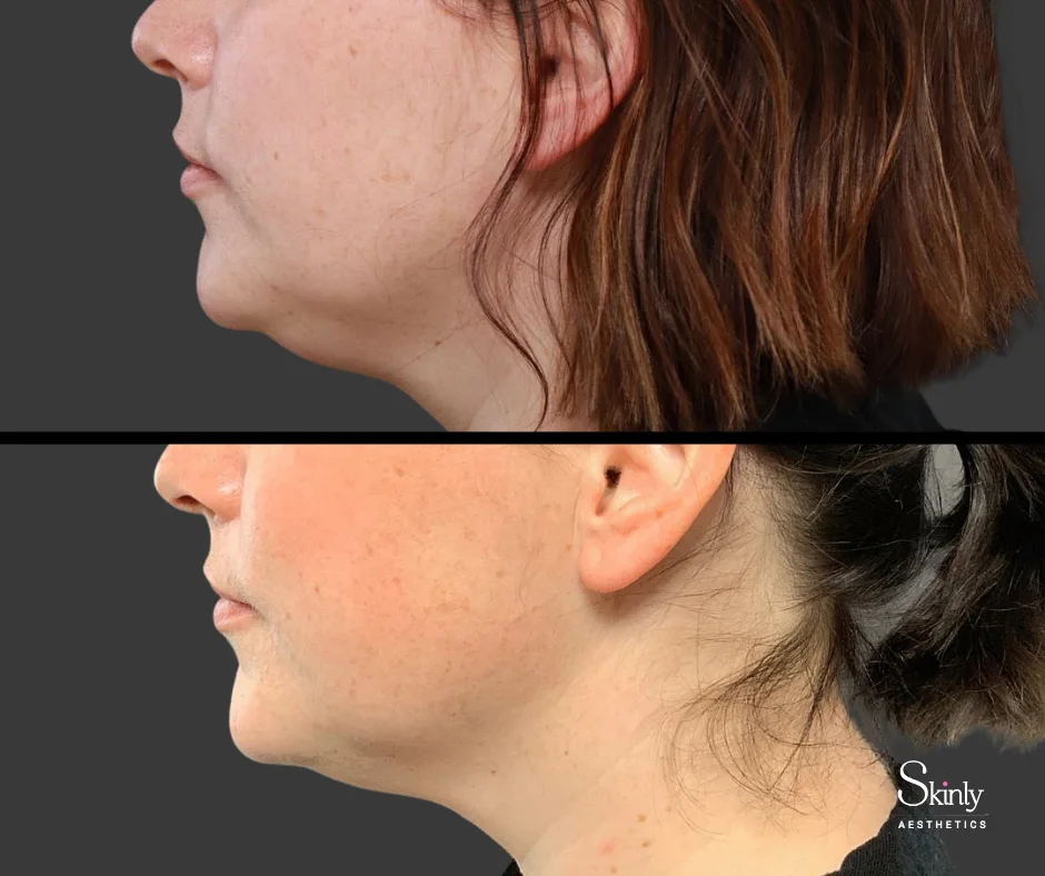 Slimmer chin and jawline after Kybella double chin removal in NYC.