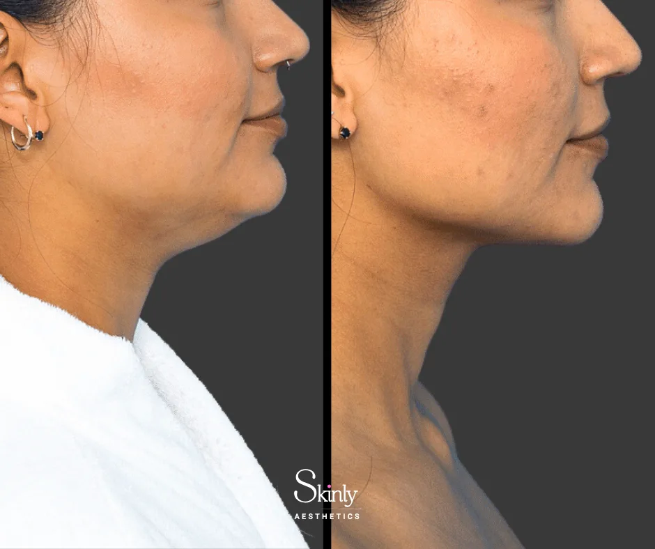 Contoured jawline after Kybella – performed by Dr. Schwarzburg in New York City.