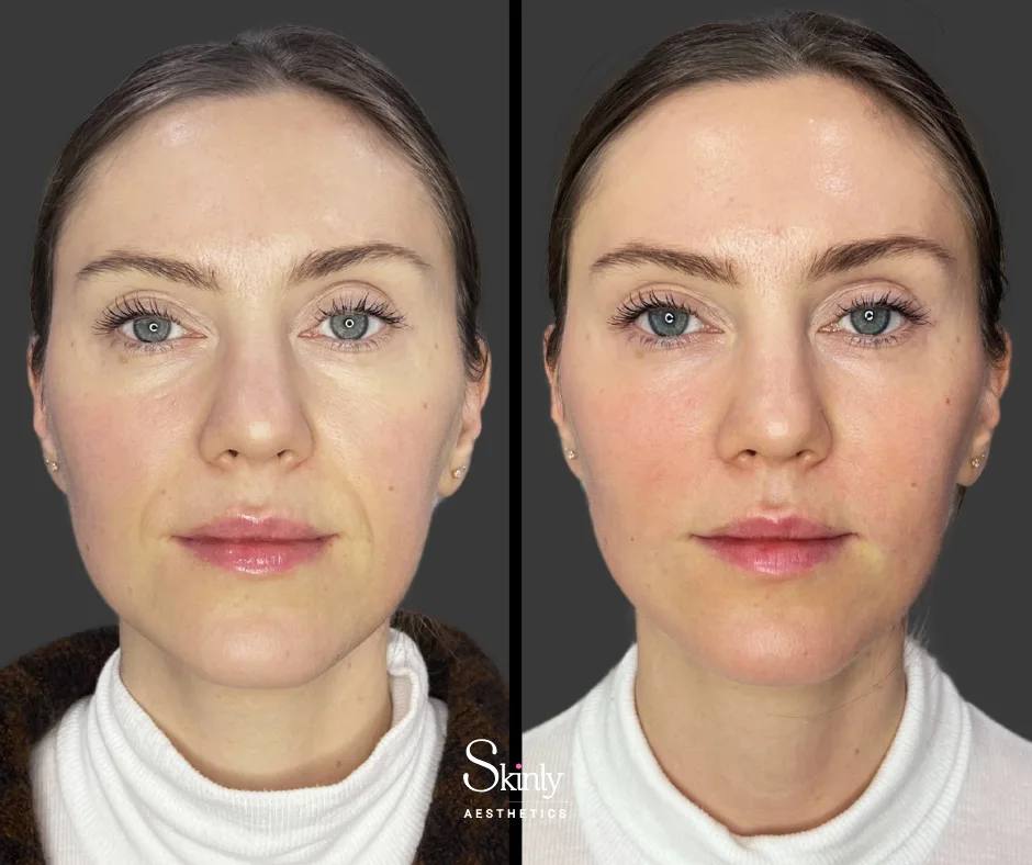 Reduced facial folds after laugh line filler.