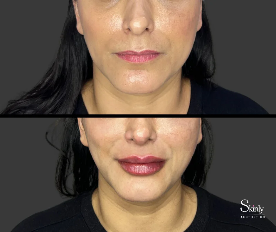 Improved fullness after lip augmentation by Dr. Schwarzburg in New York City.