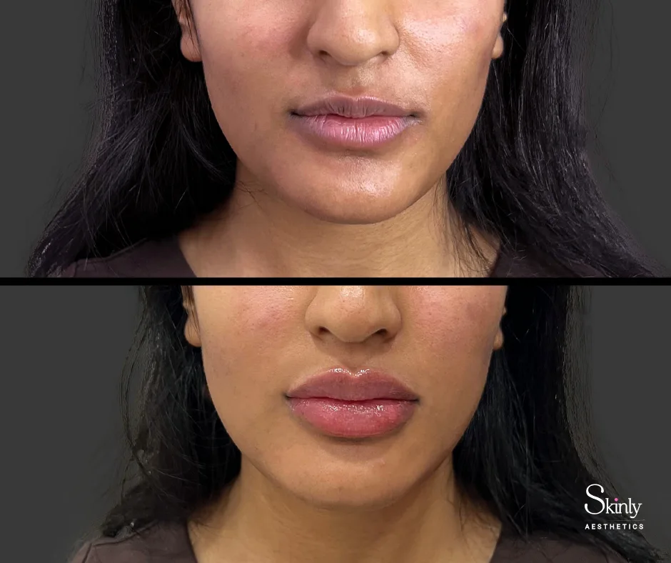 Refined lip contour after dermal filler injections.