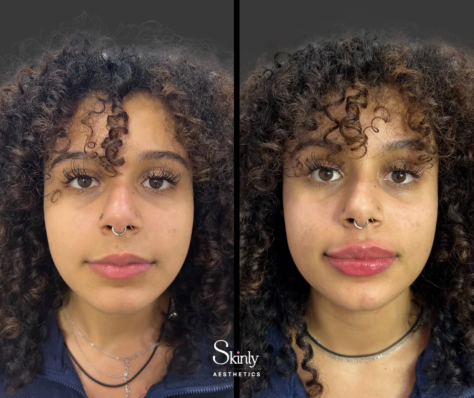 Balanced symmetry in the lips after Russian lip contouring.