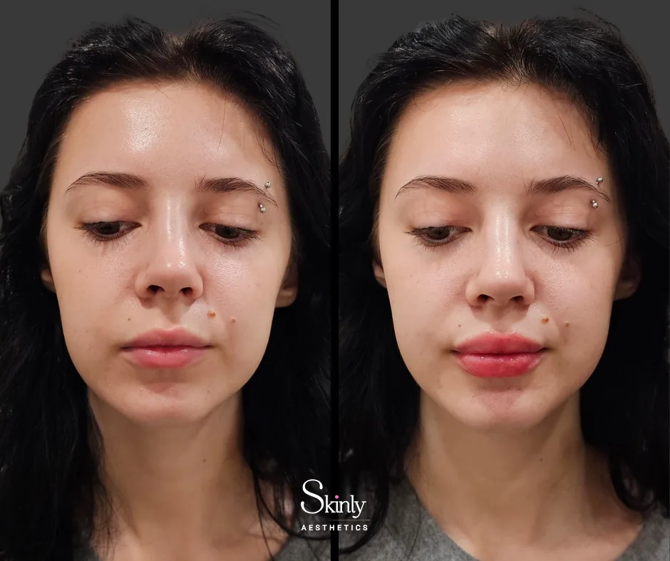 Balanced lip proportions after lip injections – performed at Skinly Aesthetics in New York City.