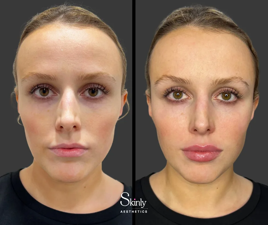 Balanced lip enhancement after lip filler injections in New York.