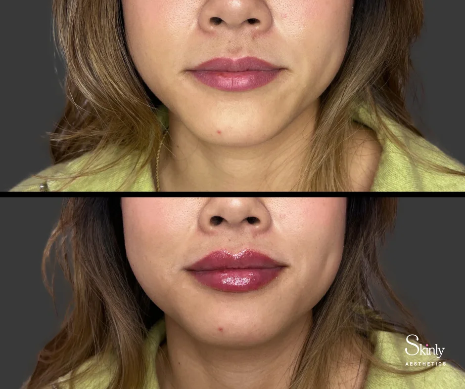 Close-up view of symmetry correction after lip filler injections.