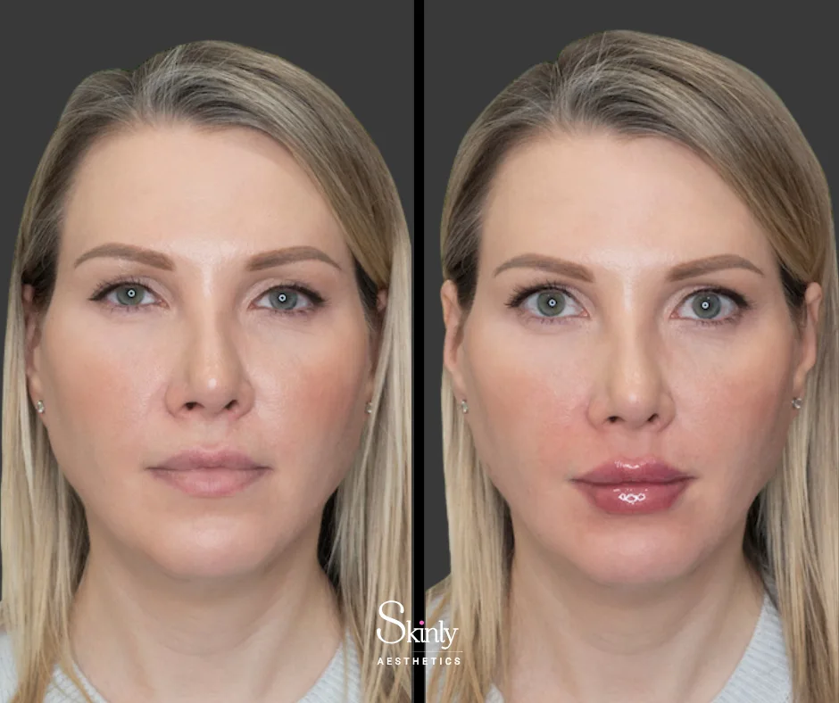 Natural lip enhancement with dermal filler – performed at Skinly Aesthetics in New York City.