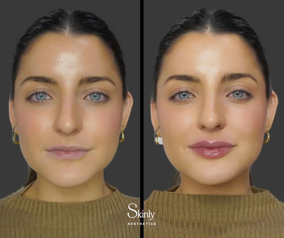Lip filler enhancing volume and refining shape – before (left) vs after (right) in NYC.