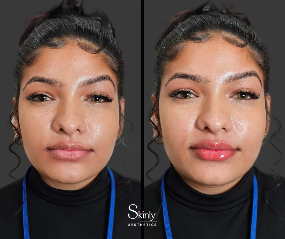 Increased volume and shape after dermal filler in the lips in New York City.