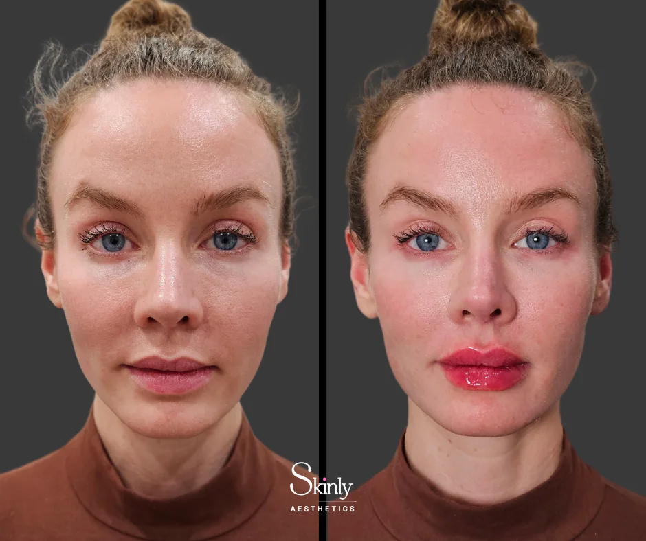 Fuller, more contoured lips after lip filler in NYC.