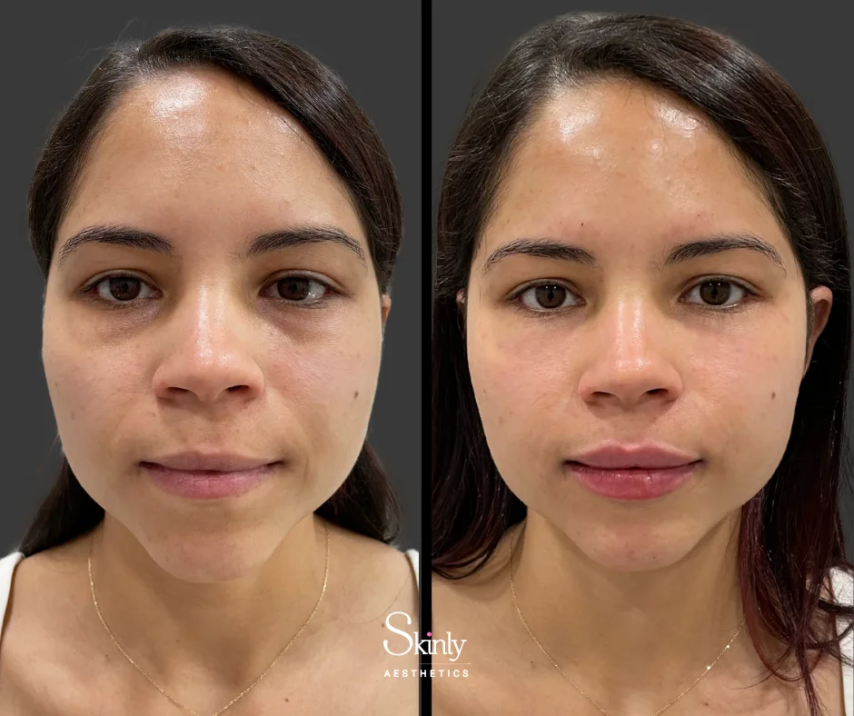 Subtle lip enhancement with dermal filler – performed at Skinly Aesthetics in New York City.