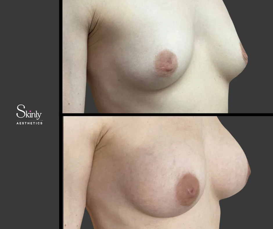 Improved lift and projection after liquid breast augmentation.