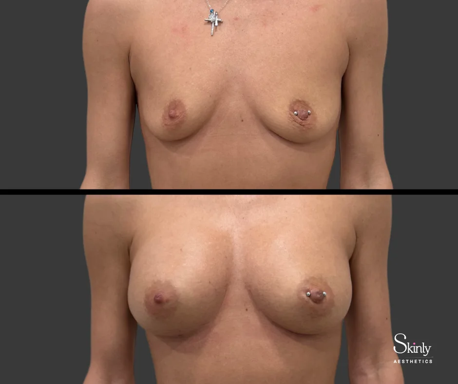 Fuller appearance after liquid breast lift – top photo before, bottom after, in NYC.