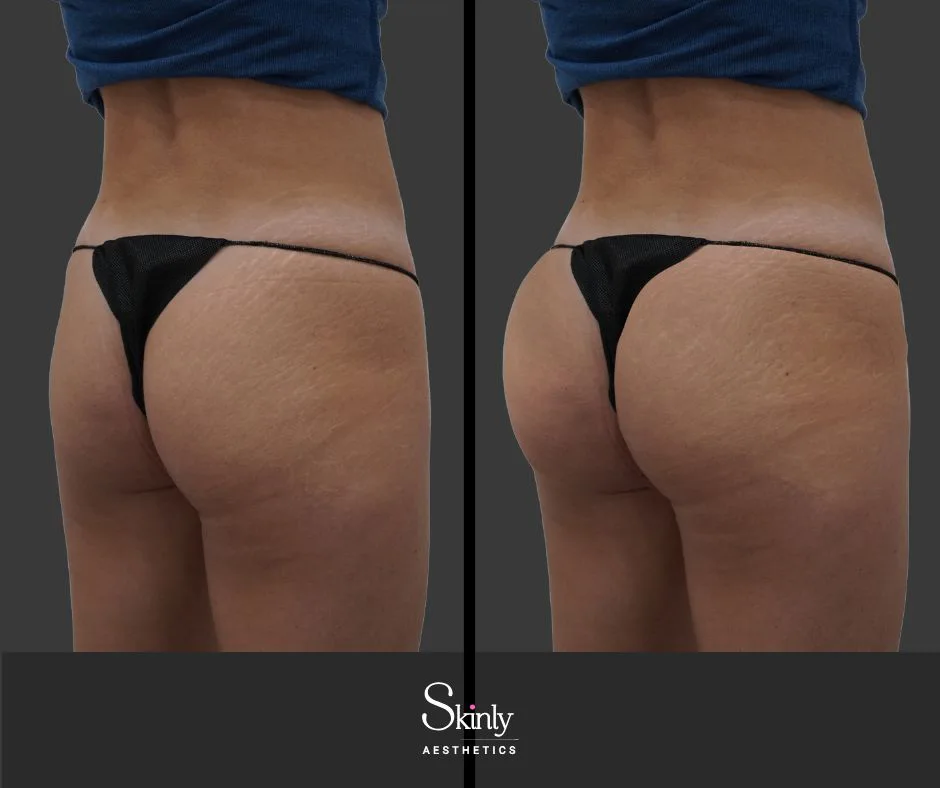 Before and after liquid butt lift for improved symmetry.