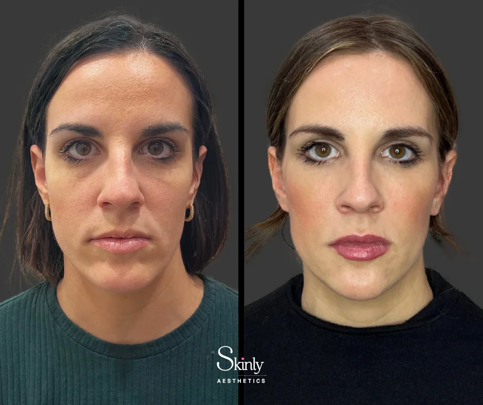 Restored facial volume after liquid facelift – before (left) vs after (right) in NYC.