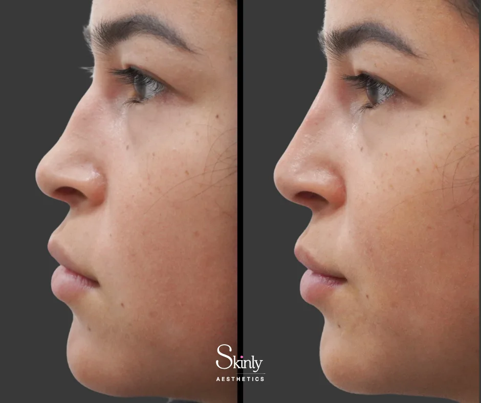 Smooth dorsal hump after nose filler – performed at Skinly Aesthetics in New York City.