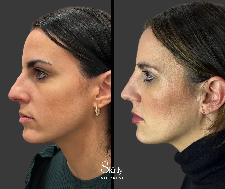 Lifted nose tip after liquid nose job – before (left) vs after (right) in NYC.