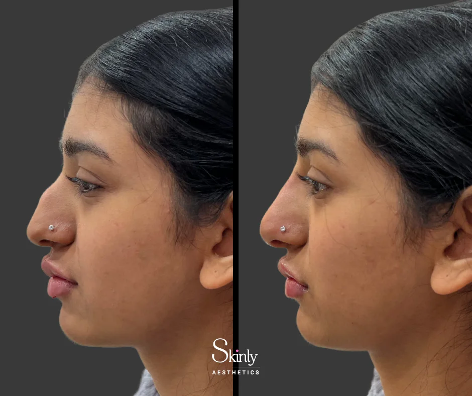 Refined nasal contour after liquid rhinoplasty – before (left) vs after (right) in NYC.
