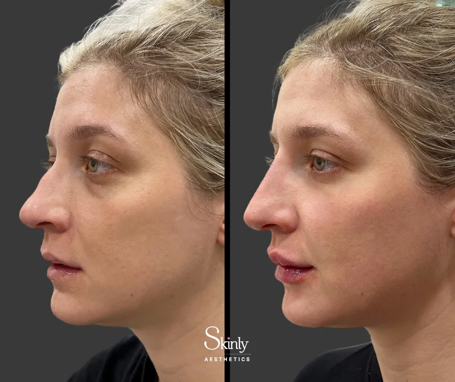 Liquid rhinoplasty correcting and refining the nasal bridge.