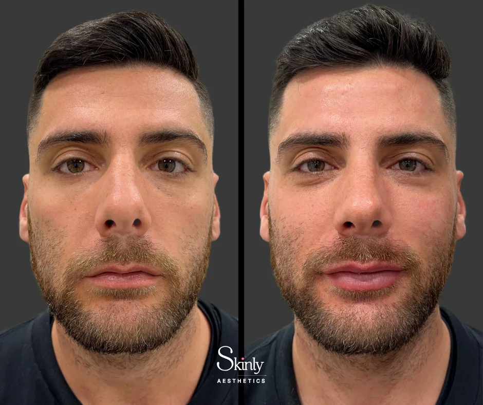 Male lip filler creating balanced lip shape and subtle volume – in NYC.