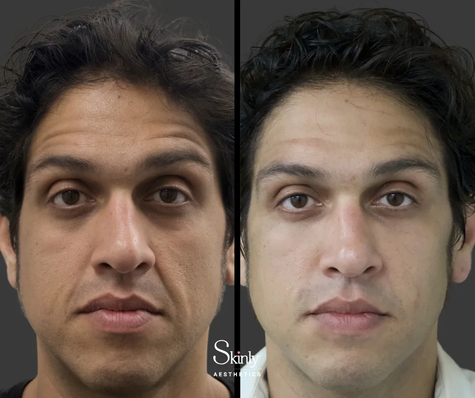 Smoothed deep facial lines after nasolabial field filler in NYC.