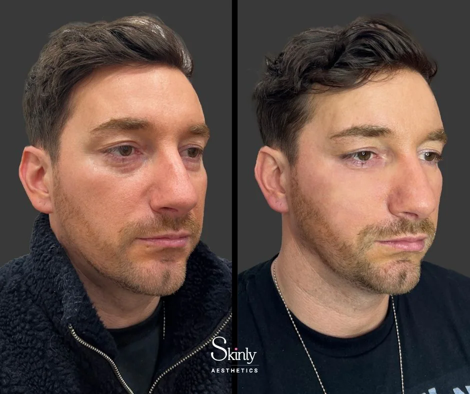 Natural under eye filler results in male patient.