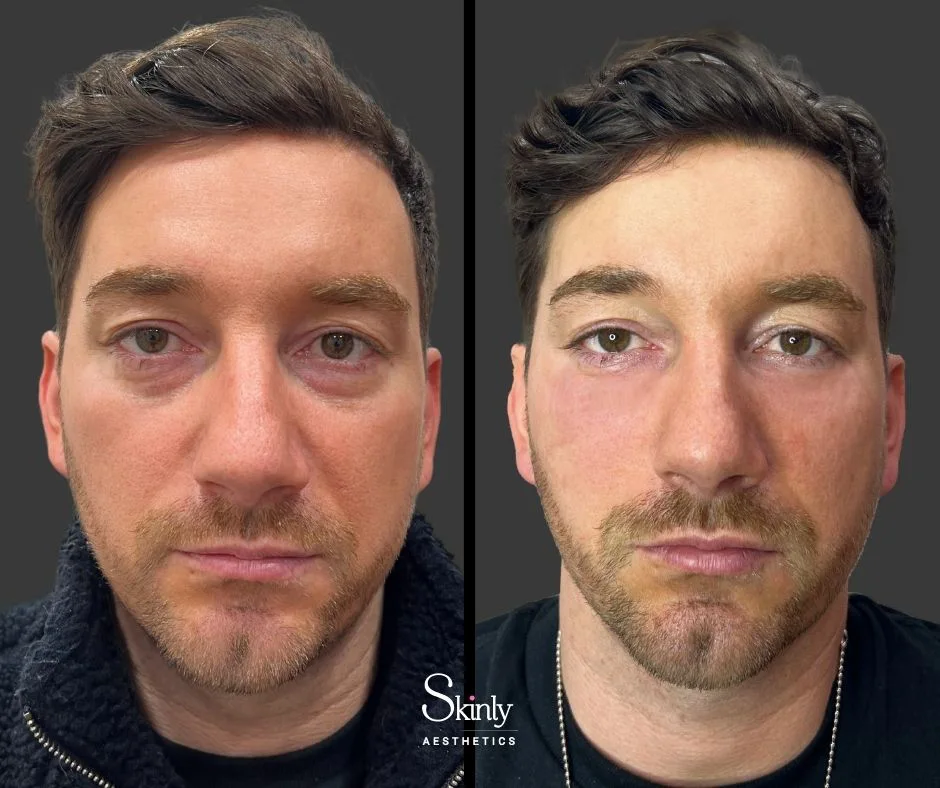 Under eye filler treatment reducing dark circles – at Skinly Aesthetics.