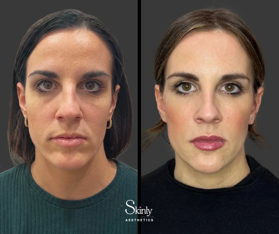 Midface filler restoring youthful volume in the cheeks.