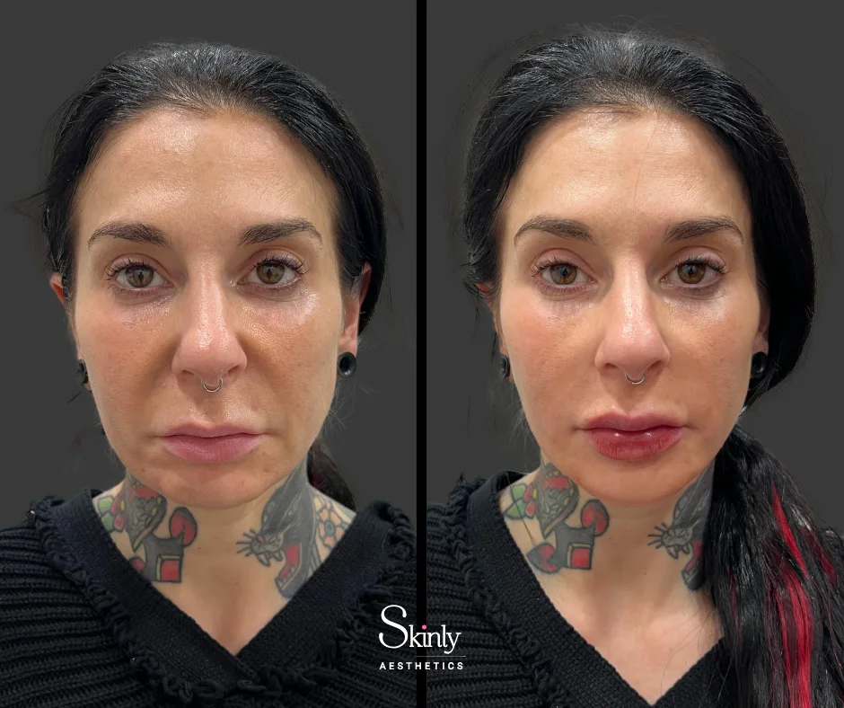 Restored smoothness in the midface after Nasolabial fold correction with filler.