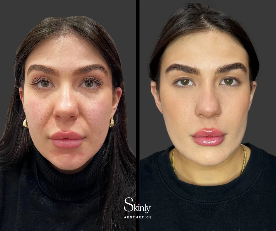 Nasolabial fold filler smoothing smile lines – before (left) vs after (right) in NYC.
