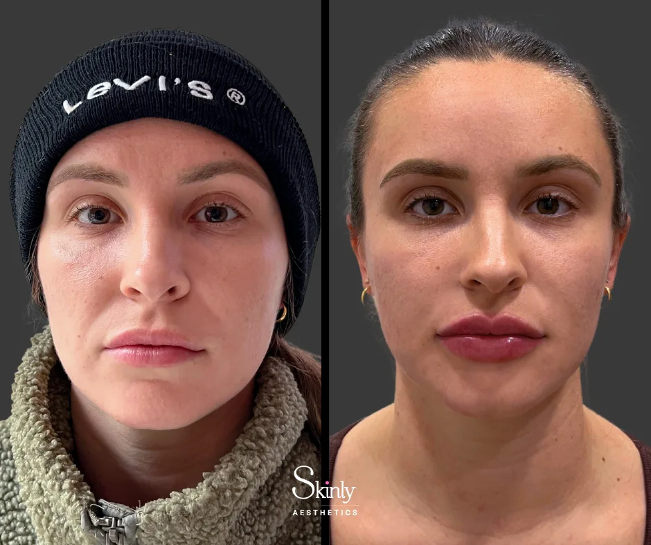 Smoother facial contours after nasolabial fold filler – by Dr. Schwarzburg in New York.